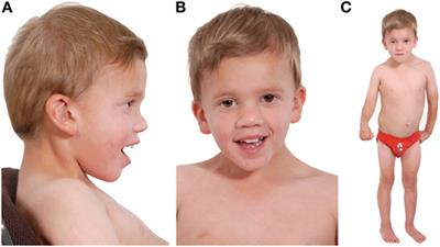 Unexpected Findings in a Child with Atypical Hemolytic Uremic Syndrome: An Example of How Genomics Is Changing the Clinical Diagnostic Paradigm